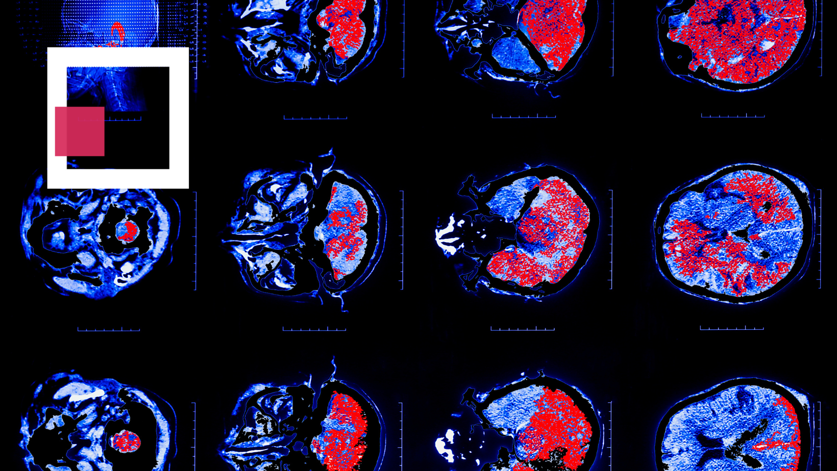 set of head MRI scans analyzed by an app, artificial intelligence in radiology