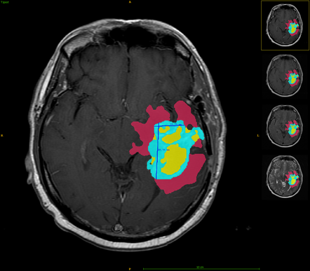 Automatic brain tumor segmentation with subregions