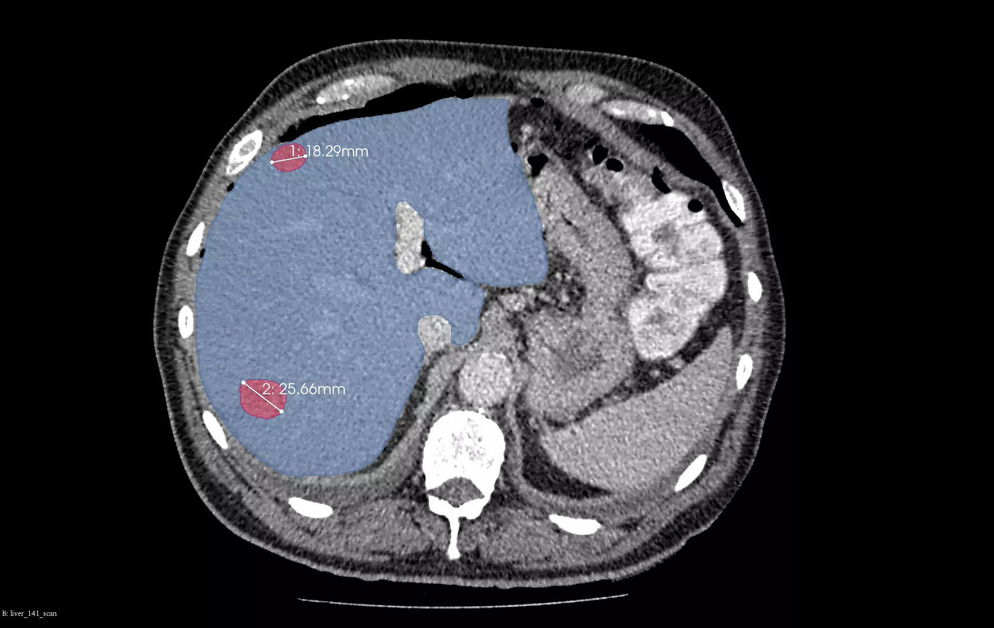 the picture depicted liver tumor segmentation after segmentation process