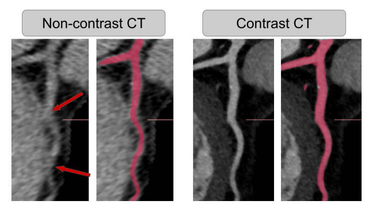 Figure that presents the challenge of segmenting the coronary vessel from non-contrast CT 