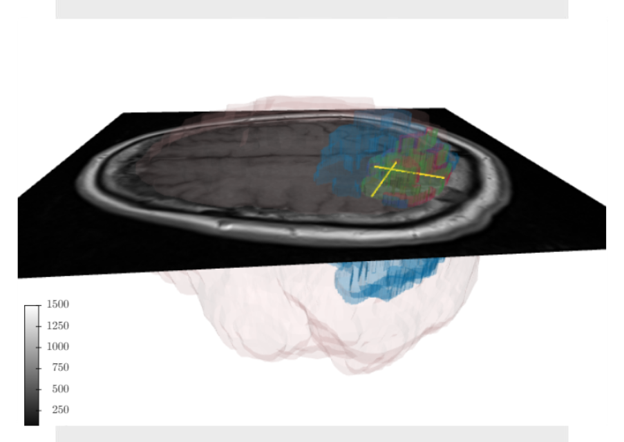 brain image with segmented subregions and performed by AI-based algorithm automatic measurements of RANO as part of measurement in medical imaging