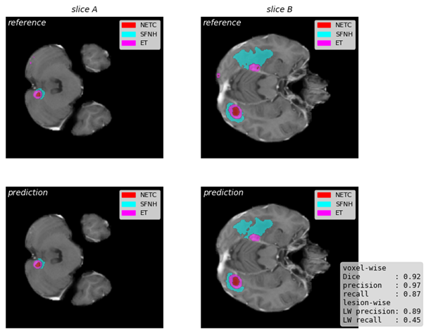 Fig. 2 Exemplary segmentation of brain metastases using a model trained for BraTS-METs 2025 challenge, with corresponding metrics; data from challenge training